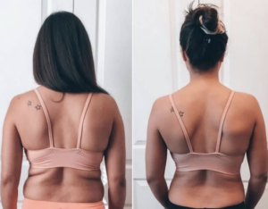 pcdc fat dissolving injections bra line results